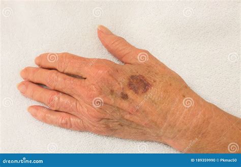 Bruise on Thin Skin of an Elderly Woman Stock Photo - Image of ...