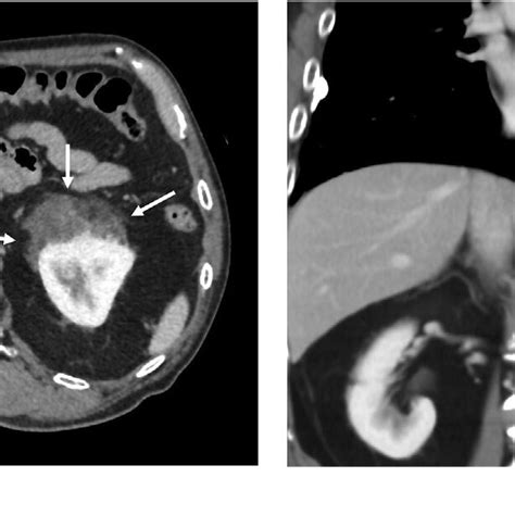 Axial A And Coronal B Contrast Enhanced Computed Tomography CT