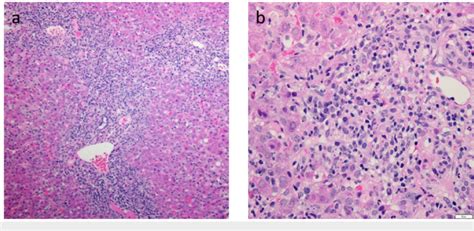 Liver Biopsy Slides Of Findings Consistent With Autoimmune Hepatitis