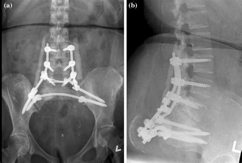 A B X Rays Lumbar Spine Ap Lateral Showing L3 To Ilium Posterior Download Scientific Diagram