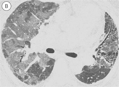 Acute Exacerbation Of Ipf In A 63 Yearold Man A Initial Hrct Scan Download Scientific