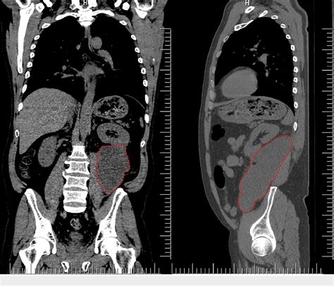 Figure 1 From Primary Retroperitoneal Hydatid Cyst A Diagnostic And Treatment Conundrum