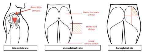 Intramuscular Injection Sites