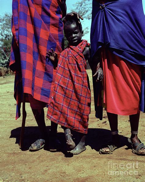 Burns Patient Photograph By Jason Kelvin Science Photo Library Pixels