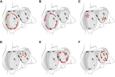 Mitral Isthmus Flutter Mon Ekg