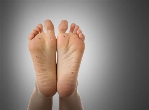 Ingrown Toenail Treatments Ottawa Foot Clinic