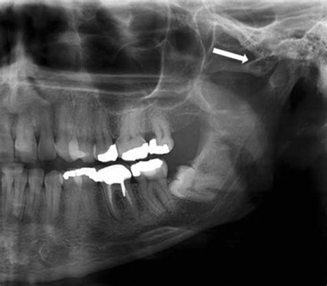 A Cropped Panoramic Radiograph Shows A Multilocular Pneumatized