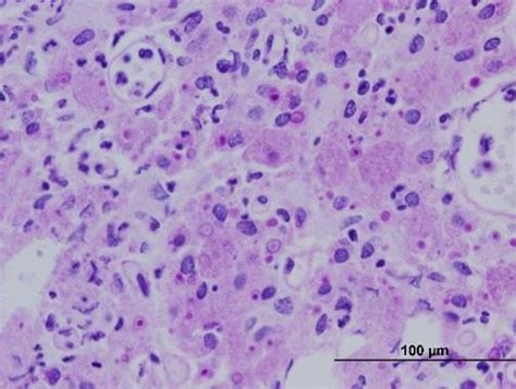 Pathology Outlines - Case of the Month #496