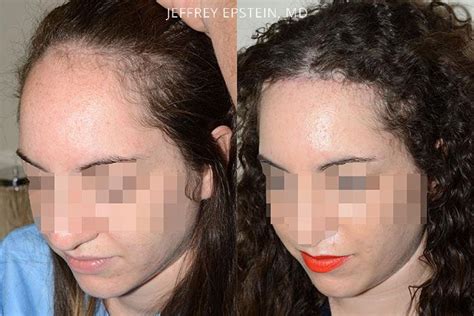 Forehead Reduction Surgery Photos Miami FL Patient37347