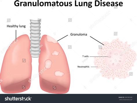 Granulomatous Lung Disease Labeled Diagram Stock Vector 399785500 : Shutterstock