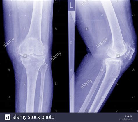 Bone Spur Stock Photos & Bone Spur Stock Images - Alamy