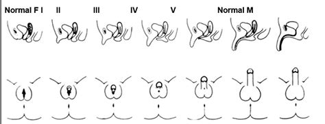 Figure 2 [different Degrees Of Virilization According To The Scale