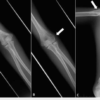 Plain Radiography Of The Fourth Fracture A Anteroposterior And B