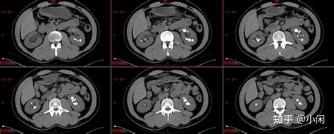 年纪轻轻肾结石频发，当心海绵肾，别等出现感染才发现 知乎