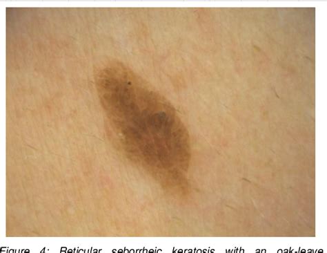 Figure 1 From Seborrheic Keratoses The Most Common Benign Skin Tumor