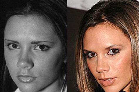 Victoria Beckham Nose Job Plastic Surgery Before and After | Celebie