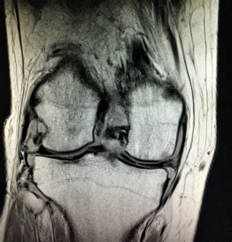 Pathologie De Rayon X De Doigt De Rhumatisme Articulaire Image Stock