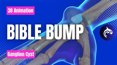 Learn About Bible Bumps Ganglion Cysts In 3d Youtube