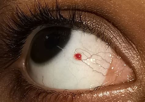 Eyelid Hemangioma