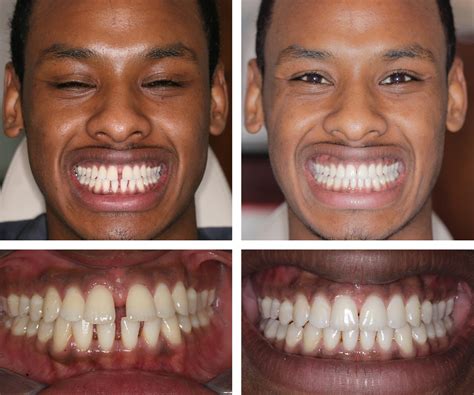 Invisalign Invisible Braces Central London W1 UK Harley Street