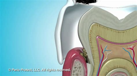 Perio Tray® By Perio Protect Non Invasive Treatment For Gum Disease