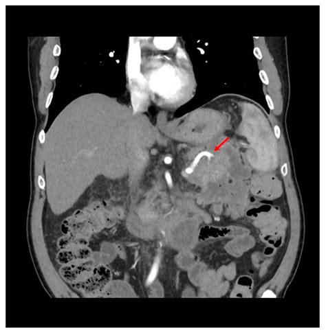 Direct Endoscopic Necrosectomy Of A Recurrent Walled Off Pancreatic