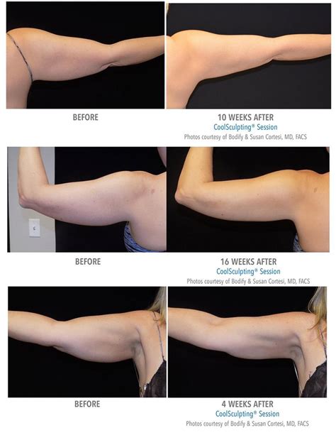 Lipo Before And After Before After Photo Body Lift Surgery