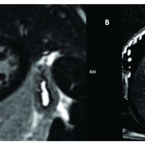 Late Gadolinium Enhancement Lge Psir Images Showing Midwall Lge In