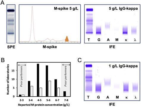 Immunofixation Shows Igm Monoclonal Protein With Kappa Light Chain ...