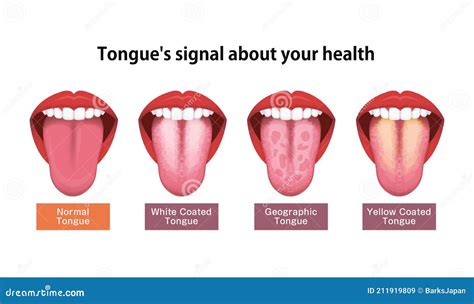 White Or Coated Tongue Dry Mouth Open Human Taste Organ With Symptoms Of Stomatitis