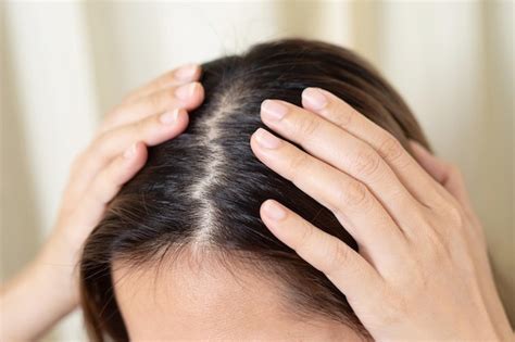 Premium Photo Dandruff Is Caused By Yeast Like Fungi Malassezia