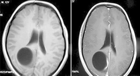 A T W Brain Mri Without Contrast Shows An Ovalshaped Intraaxial