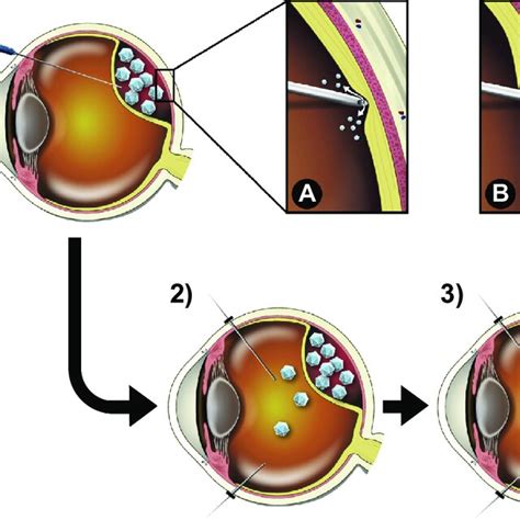 1e4 Subretinal Injection Followed By Intravitreal Lavage With Balanced