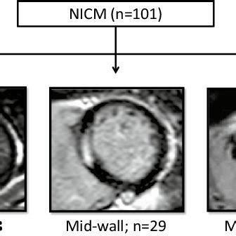 Late Gadolinium Enhancement Patterns All 101 Patients With