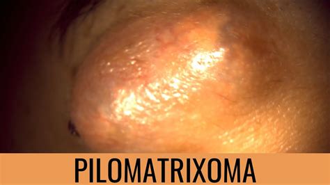 Pilomatrixoma Removiendo Tumor Benigno de Párpado YouTube