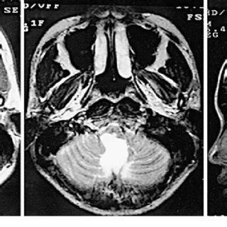 Left Preoperative Axial T Weighted Magnetic Resonance Mr Image