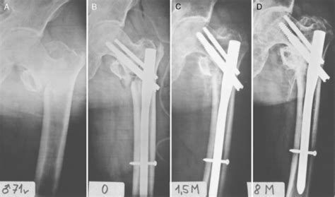 Complications of Trochanteric Fractures | Musculoskeletal Key