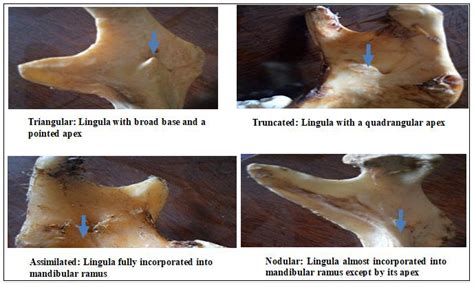 Images Showing Different Shapes Of Lingula Download Scientific Diagram