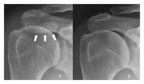 Treatment Protocol For Rotator Cuff Calcific Tendinitis Using A Single