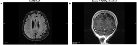 Frontiers | Rheumatoid Meningitis