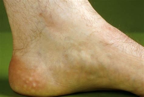 Bilateral Piezogenic Papules Of The Heel - Painful nodules and plaques ...