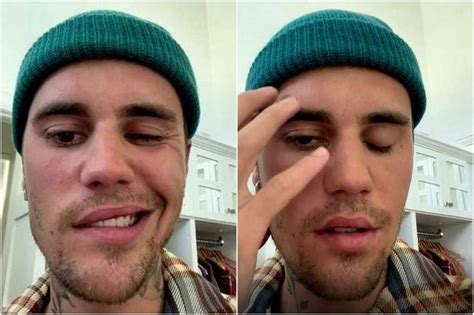 Singer Justin Bieber Shows His Recovery From Partial Facial Paralysis