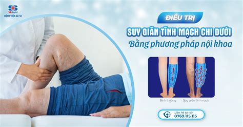 Điều trị suy giãn tĩnh mạch chi dưới bằng phương pháp nội khoa Bệnh