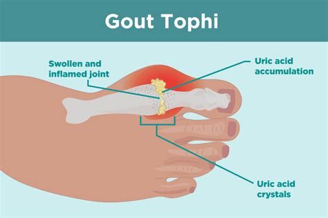 Pathophysiology Gout