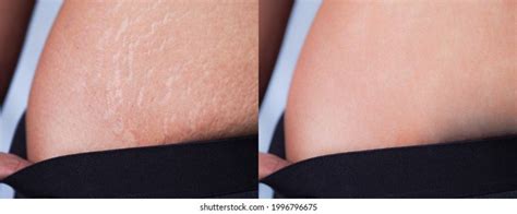 Image Before After Skin Stretch Marks Stock Photo 1996796675 Shutterstock