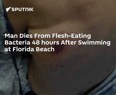 Man Dies From Flesh Eating Bacteria 48 Hours After Swimming At Florida