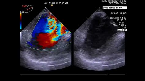 Transesophageal Echocardiogram Shows Color Turbulence By Perforated