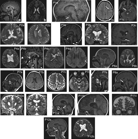 Brain Magnetic Resonance Imaging Mri Findings T1 And T2 Images A Download Scientific