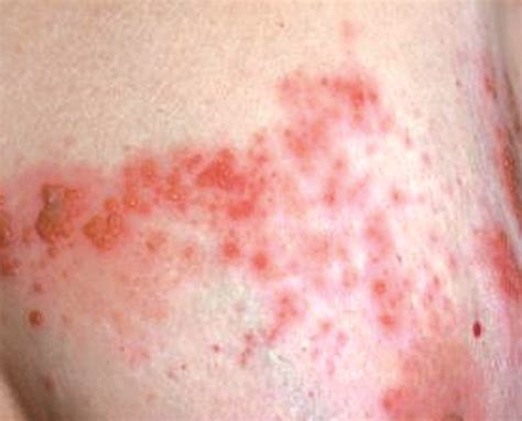 Herpes Zoster Clinical Aspects And Prevention Strategies For Patients