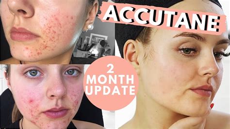 2 MONTH ACCUTANE UPDATE SIDE EFFECTS IS IT WORKING Conagh